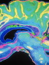 Ask Gerda: Are There Side Effects from MRI Contrast Dyes?
