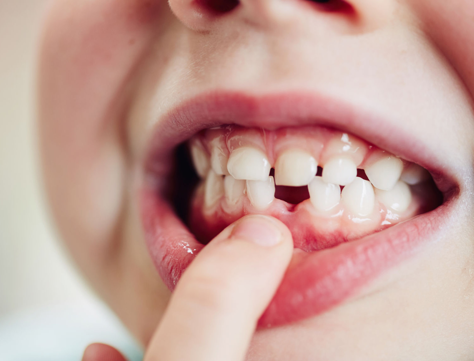 What Can Baby Teeth Tell Us about Autism and Heavy Metals?