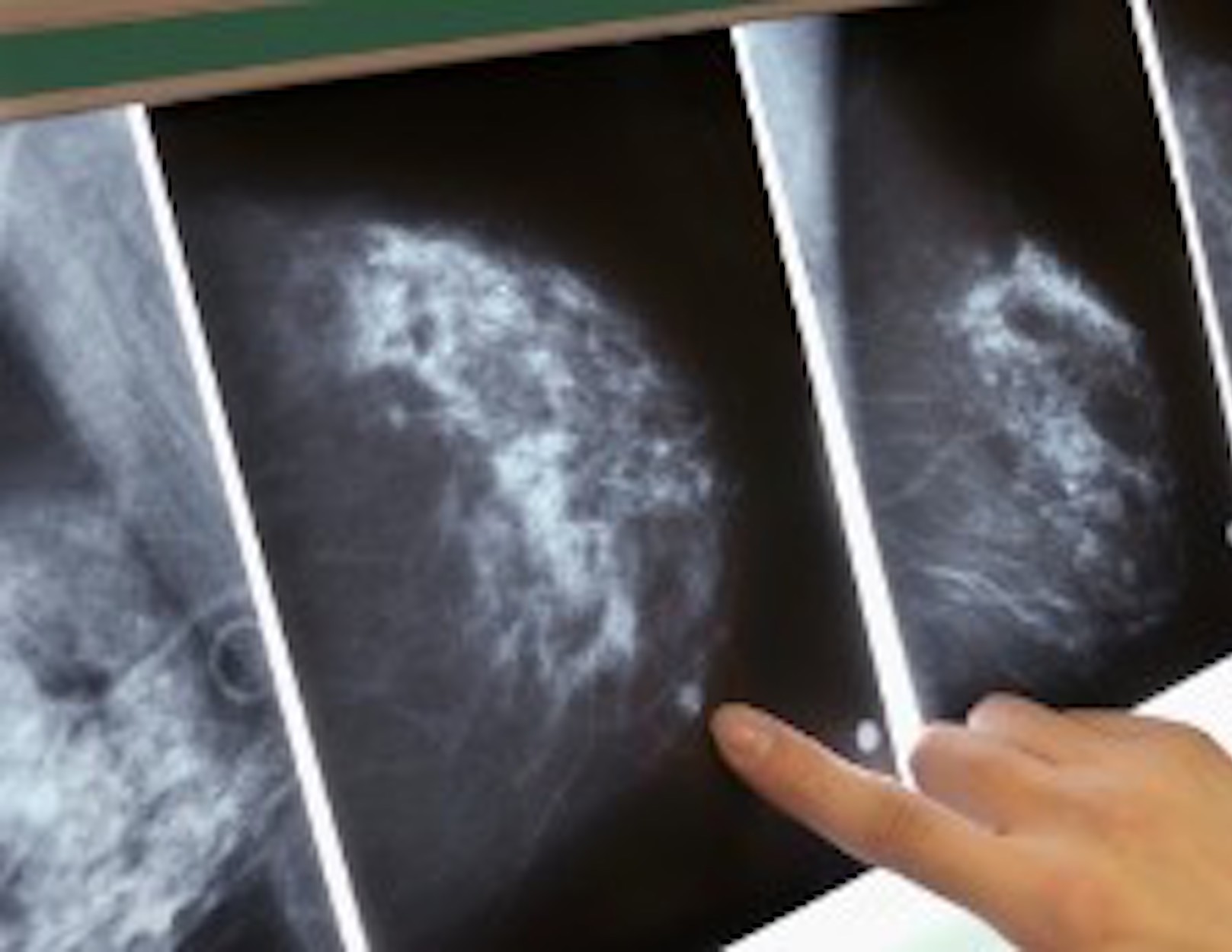  FDA Proposes Changes to Mammography Standards for First Time in More than 20 Years