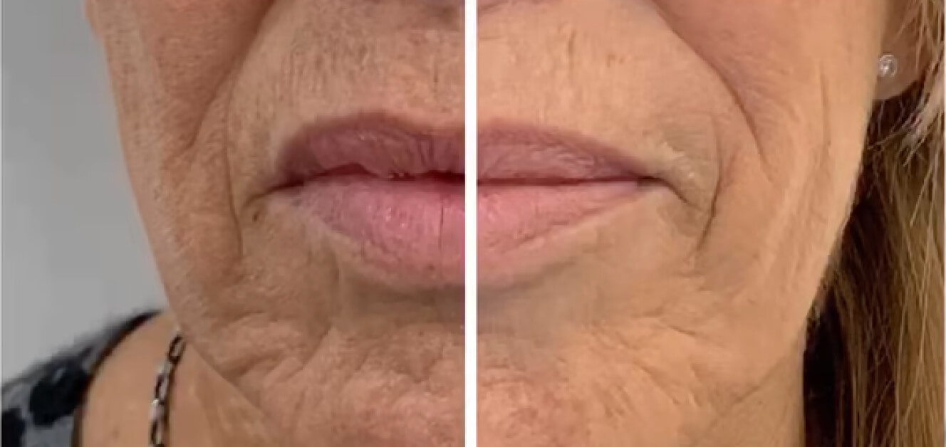 LYMA Laser Before & After