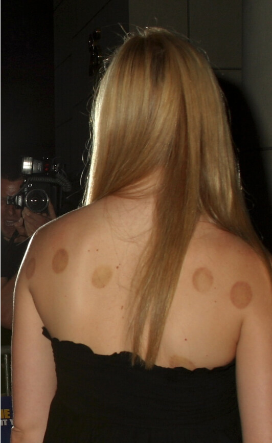 GP with cupping marks on her back